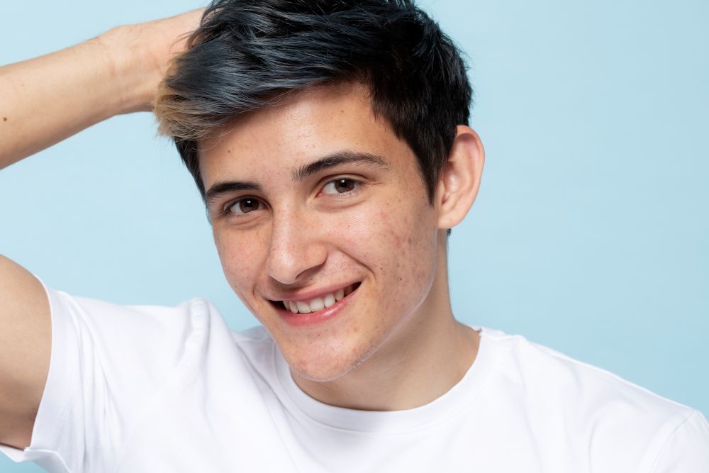Pria dengan wajah berjerawat sedang tersenyum. Image by freepik